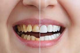 SnapSmile™ - Set de 2 Carillas Dentales (Superior + Inferior)