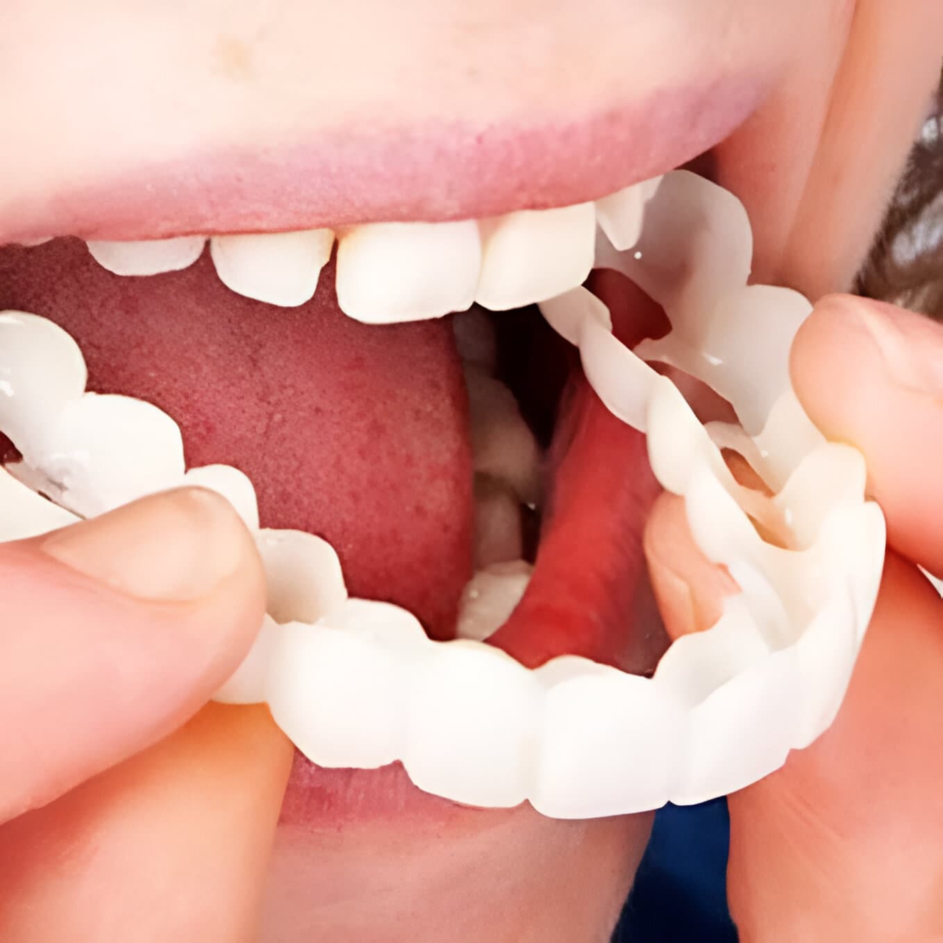 SnapSmile™ - Set de 2 Carillas Dentales (Superior + Inferior)